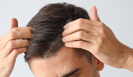 Doenças de cabelo mais comuns no verão
