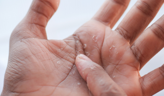 Disidrose ou alergia: entenda as diferenças entre as condições