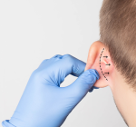 Cirurgia de Otoplastia é a melhor maneira para corrigir a “orelha de abano”