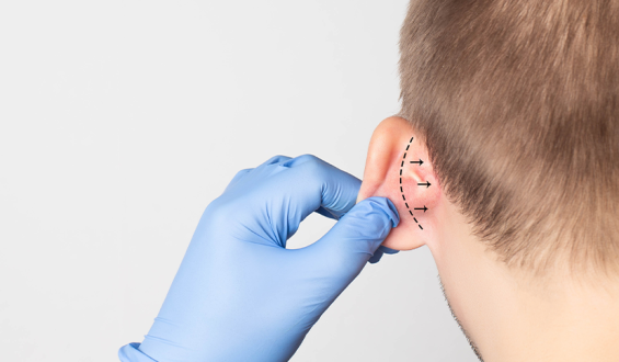 Cirurgia de Otoplastia é a melhor maneira para corrigir a “orelha de abano”