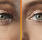 A nova técnica para renovação da pele de forma segura