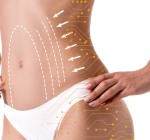 Descubra as inovações tecnológicas na lipoaspiração