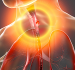 Quando o refluxo pode evoluir para um câncer?