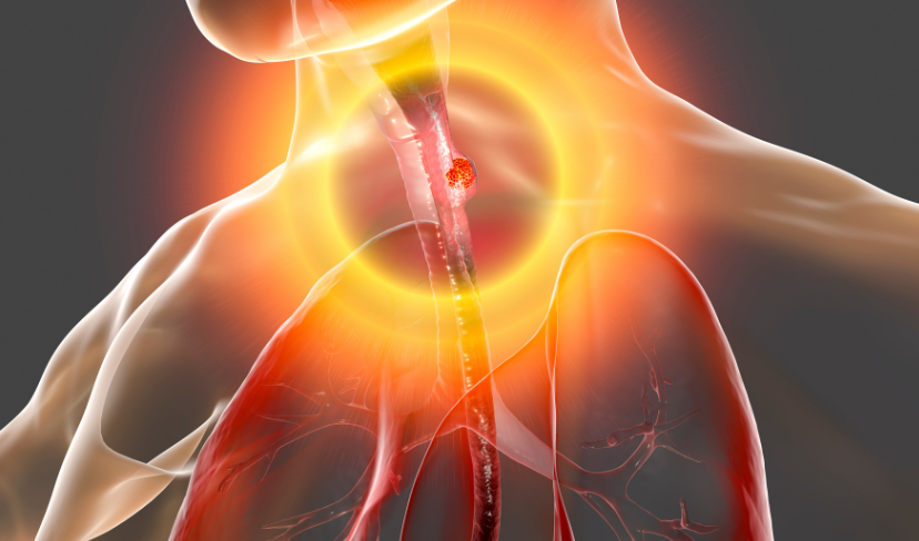 Quando o refluxo pode evoluir para um câncer?