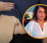 Existe vida sim com colostomia, Preta Gil é a prova disso