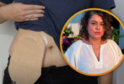 Existe vida sim com colostomia, Preta Gil é a prova disso