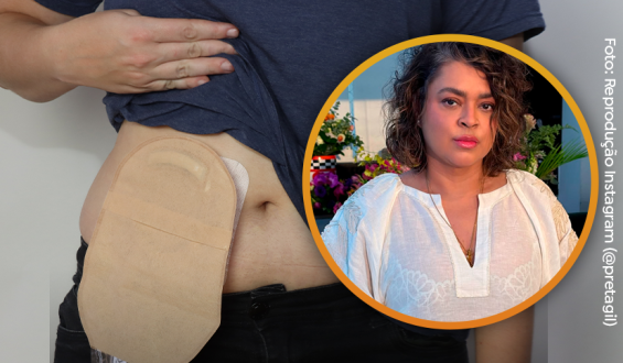 Existe vida sim com colostomia, Preta Gil é a prova disso
