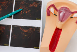Embolização uterina é excelente alternativa no tratamento de miomas e  na preservação do útero
