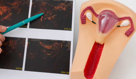 Embolização uterina é excelente alternativa no tratamento de miomas e  na preservação do útero
