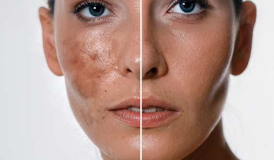 O que há de novo para o tratamento do melasma