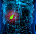 A vesícula inflamada não pode ser ignorada!