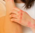 Alergia alimentar: tratamento com dessensibilização amplia possibilidades e melhora a qualidade de vida