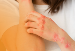 Alergia alimentar: tratamento com dessensibilização amplia possibilidades e melhora a qualidade de vida