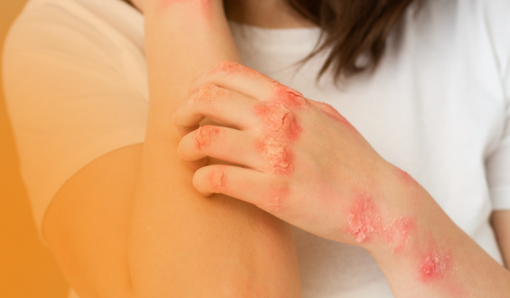 Alergia alimentar: tratamento com dessensibilização amplia possibilidades e melhora a qualidade de vida