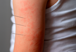 Sofrendo com alergias? A acupuntura pode ser a solução e a ciência comprova!