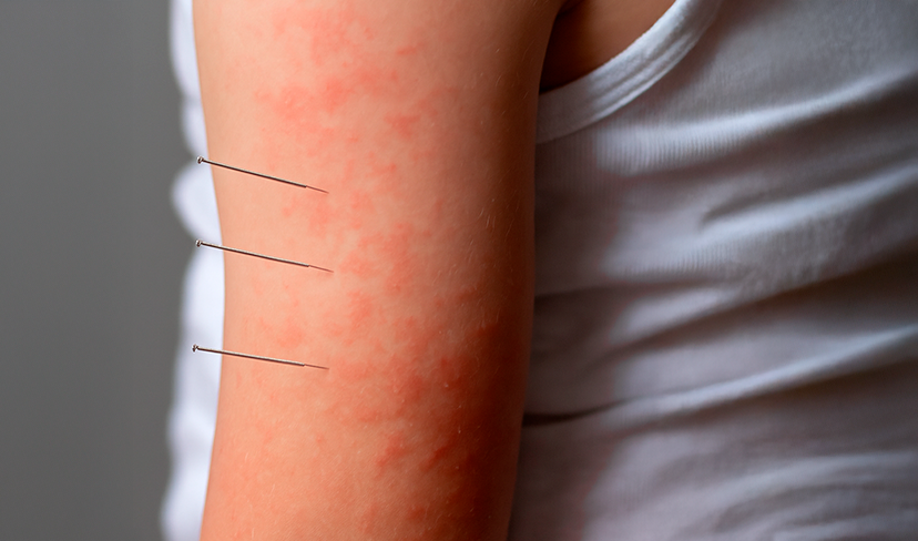 Sofrendo com alergias? A acupuntura pode ser a solução e a ciência comprova!