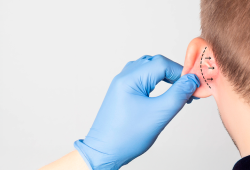 Otoplastia em foco: especialista alerta para os riscos da técnica “sem corte”