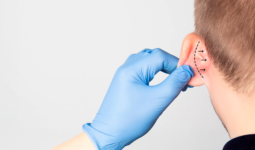 Otoplastia em foco: especialista alerta para os riscos da técnica “sem corte”