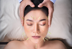 Como a acupuntura trata os sintomas relacionados ao estresse