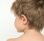 Otoplastia Infantil: Corrigindo as Orelhas de Abano e Resgatando a Autoestima