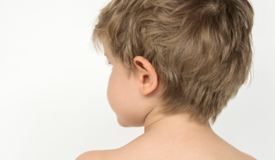 Otoplastia Infantil: Corrigindo as Orelhas de Abano e Resgatando a Autoestima