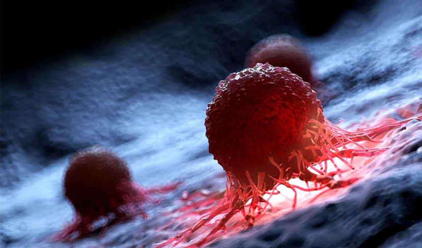 Novo estudo da Fundação do Câncer revela que mais de 60% dos casos de câncer colorretal são diagnosticados em estágios avançados da doença