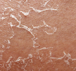 Por que a pele descasca depois de tomar sol?