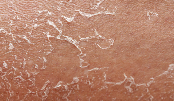 Por que a pele descasca depois de tomar sol?