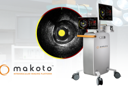 Nova tecnologia detecta placas de gordura nas artérias e pode identificar pacientes com alto risco de infarto meses ou anos antes do evento