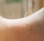 Ansiedade infantil e adolescente: como a acupuntura pode ajudar no controle emocional