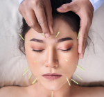 Os benefícios da acupuntura para a saúde mental