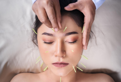 Os benefícios da acupuntura para a saúde mental