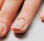 Infecção após fazer as unhas pode evoluir e exigir cirurgia