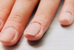 Infecção após fazer as unhas pode evoluir e exigir cirurgia