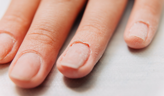 Infecção após fazer as unhas pode evoluir e exigir cirurgia
