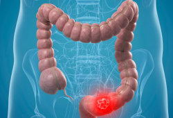 Câncer colorretal cresce entre adultos jovens e já representa 1 em cada 5 novos casos antes dos 55 anos