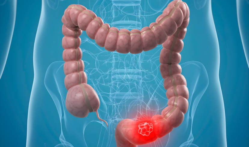 Câncer colorretal cresce entre adultos jovens e já representa 1 em cada 5 novos casos antes dos 55 anos