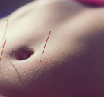 Endometriose em foco no Março Amarelo: Acupuntura como aliada no tratamento