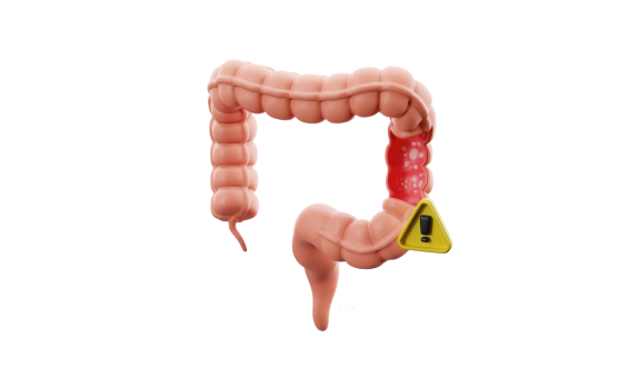 Doença de Crohn em crianças: estudo chama atenção para diagnóstico tardio
