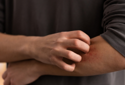 Sua pele arde, pinica, fica vermelha? Faça o teste e saiba se ela é sensível