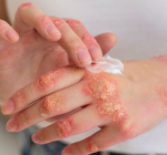 Pegou micose na academia? Saiba como evitar infecções de pele