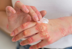 Pegou micose na academia? Saiba como evitar infecções de pele