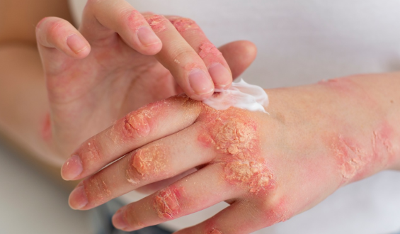 Pegou micose na academia? Saiba como evitar infecções de pele