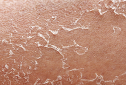 5 Sinais de que sua pele está desidratada