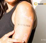Vitiligo não é contagioso e vai muito além da pele