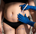 Nem todo emagrecimento é igual: entenda as diferenças entre medicamentos e cirurgia bariátrica