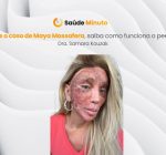 Após o caso de Maya Massafera, saiba como funciona o peeling