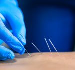 Acupuntura, TDAH e ansiedade: quando a técnica chinesa pode ser uma opção complementar