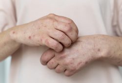 Alerta sobre o Sarampo: Riscos, Sintomas e a Importância da Vacinação | Dr. Marcelo Neubauer
